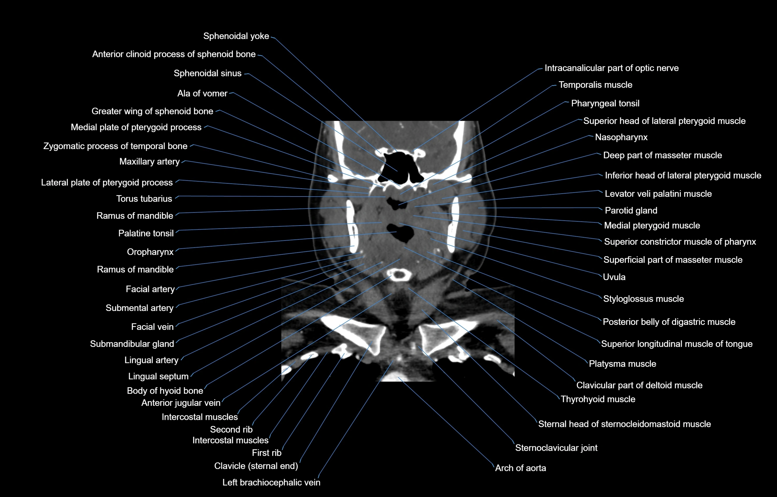 CT Neck coronal  cross sectional anatomy labelled 3D  radiology  image-00028.webp